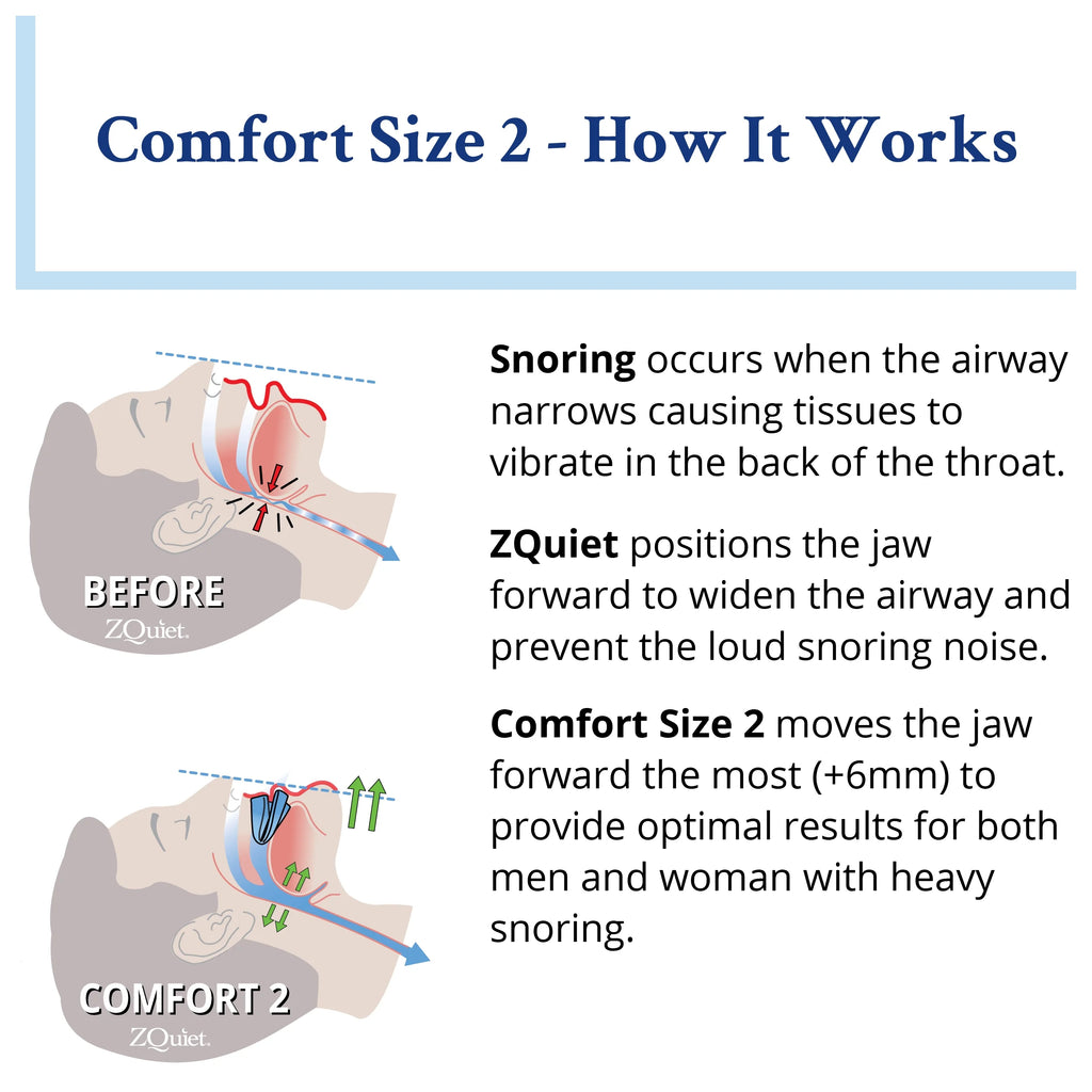 ZQuiet Anti-Snoring Mouthpiece Comfort Size #2 - Made in USA U68077