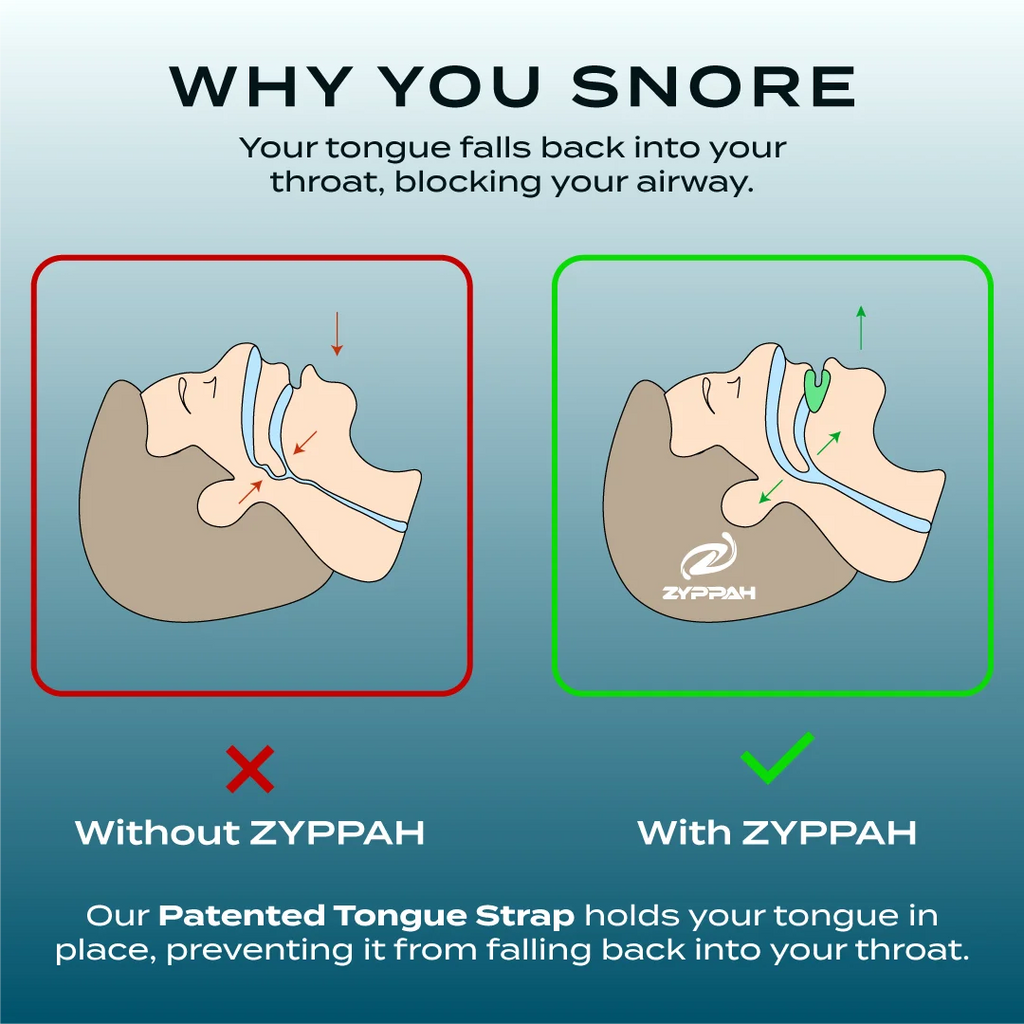 ZYPPAH Original Anti Snoring Oral Appliance Z8700