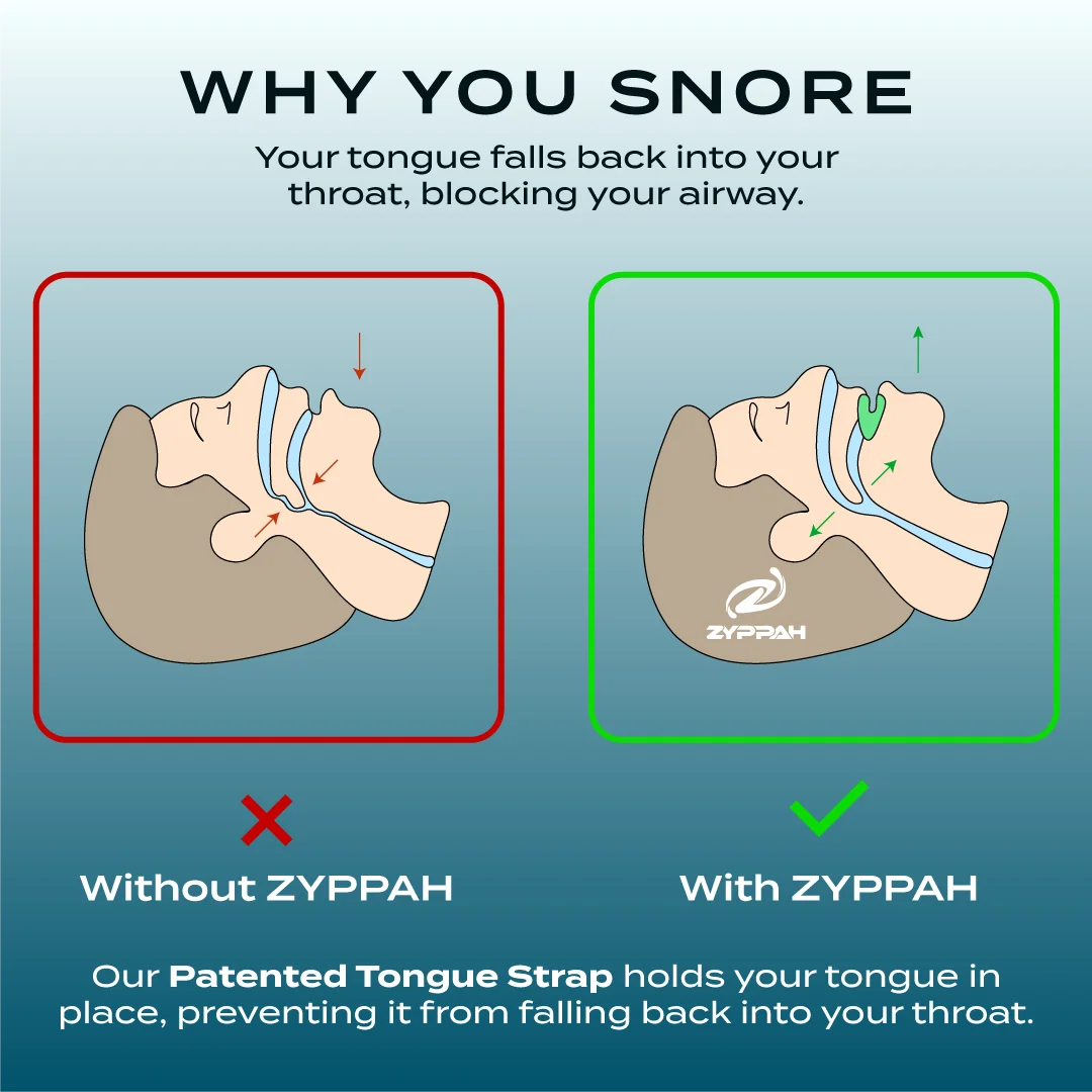 ZYPPAH Original Anti Snoring Oral Appliance Z8700